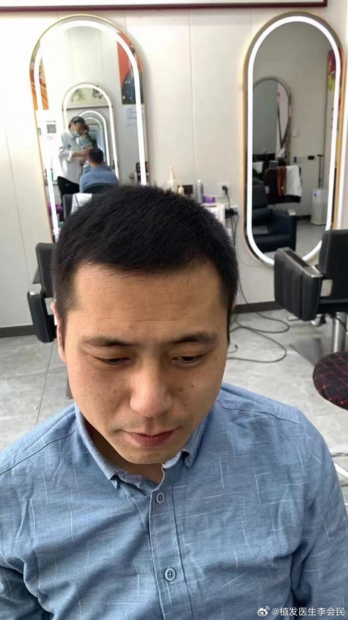 男人植发容易吗(男人植发影响备孕吗)