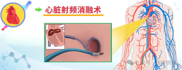 心臟跳得快了慢了都屬於心律失常這種辦法或可根治