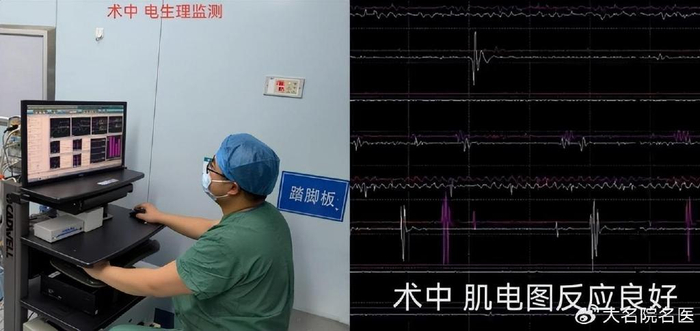 开启测试模式后,在手术中调节电刺激参数,李女士肌电图显示良好反应