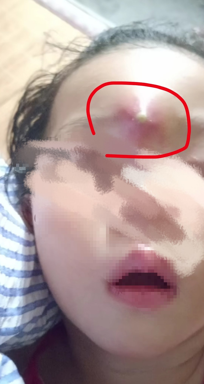 孩子眉毛中间,长了个很大的脓包!