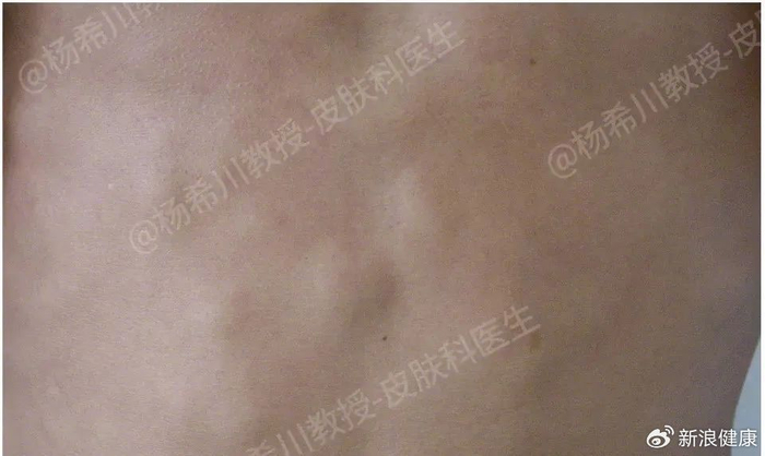 痘痘,囊肿,脂肪瘤,它们仨有啥区别?