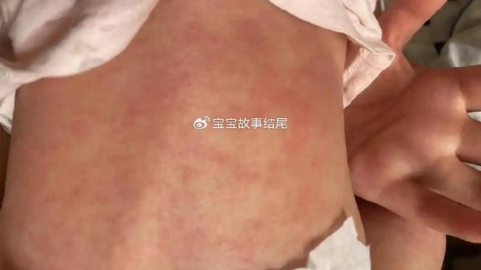 反复出现这样的“湿疹”，可能是牛奶过敏，很多妈妈不知道