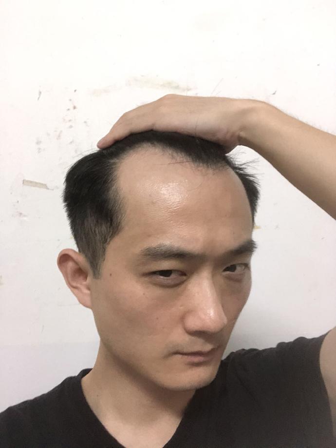 刘先生属于典型的m型发际线,通过植发改善后整个人看起来都精神了