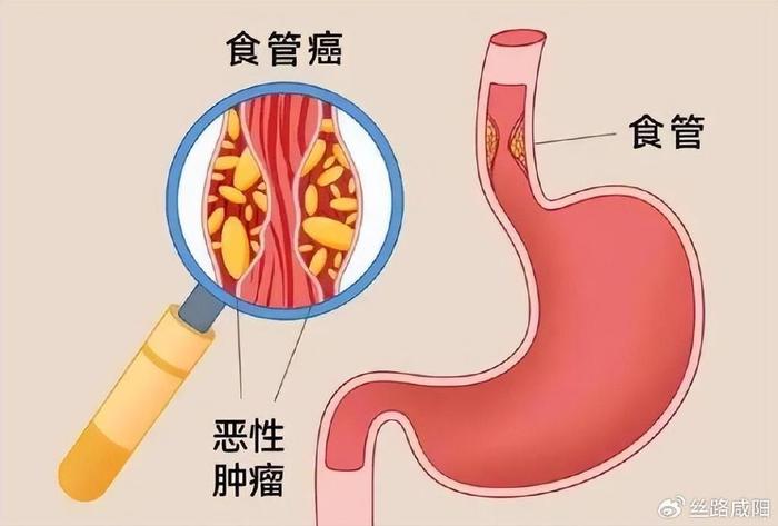 咸阳市中心医院——放射治疗:让食管癌老人顺畅吃饭