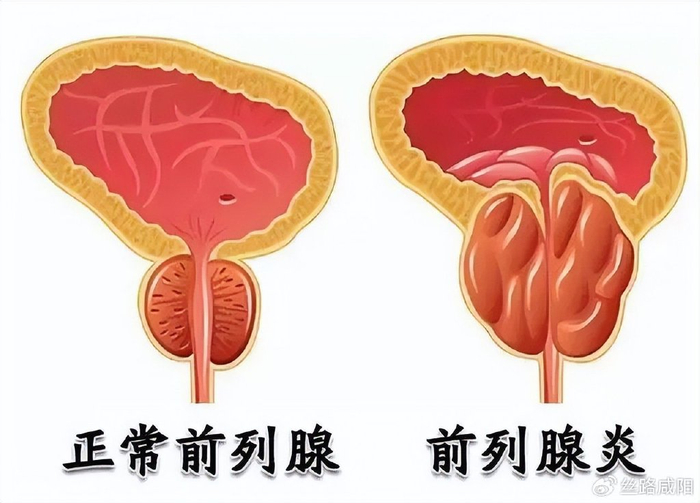 前列腺疾病最怕这个穴陕中二附院八髎liáo穴3寸毫针解病痛