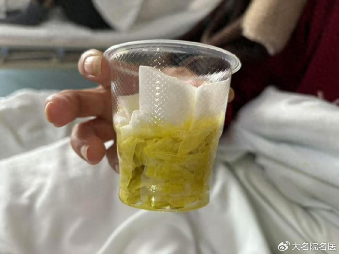 咳出黄绿色浓痰竟是胆汁?专家提醒:警惕肝内结石“霍霍”你的肺|胆管结石|肝胆管结石|肺部疾病|疫情|手术_新浪新闻