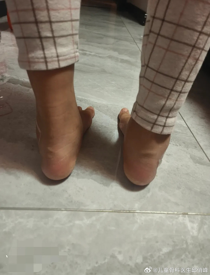 一个月后,有什么不同,足弓已经很明显!