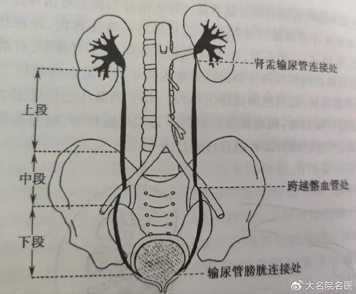 尿路结石位置图片