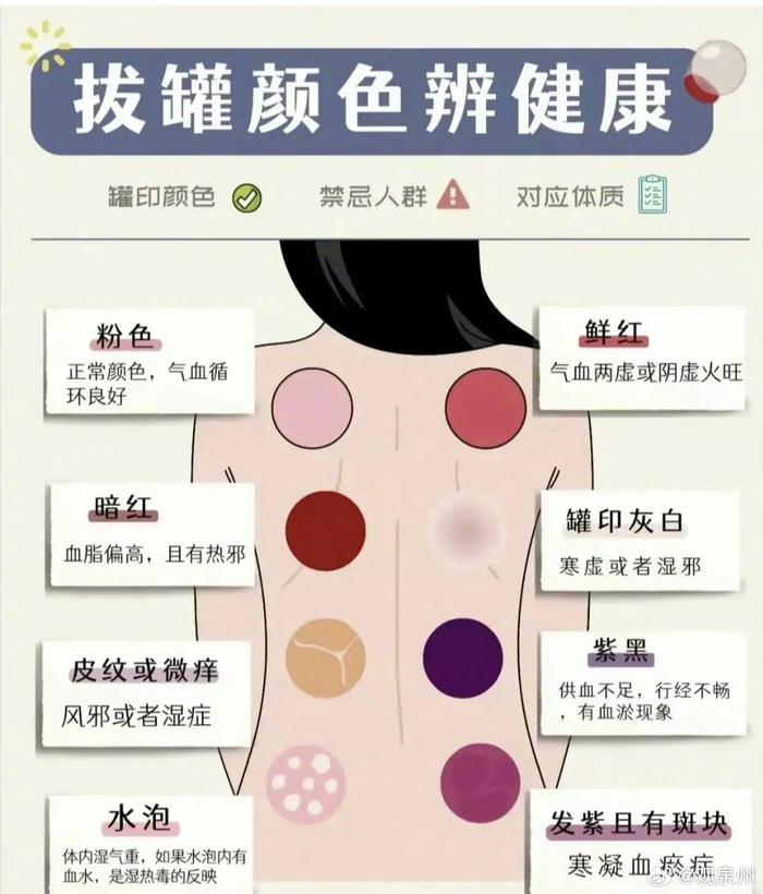 拔罐后的不同颜色代表的含义不同哦