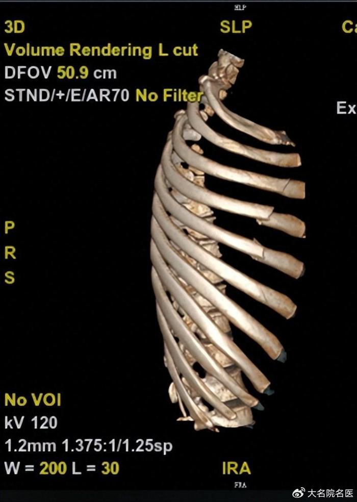 胸部ct三维重建提示其右侧第3,4,5,6肋骨骨折并胸膜挫伤,第4,5肋骨