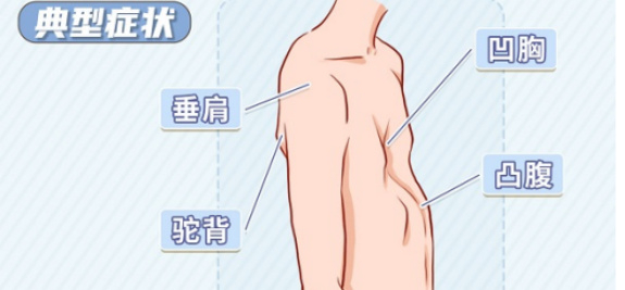 胸骨凹陷严重