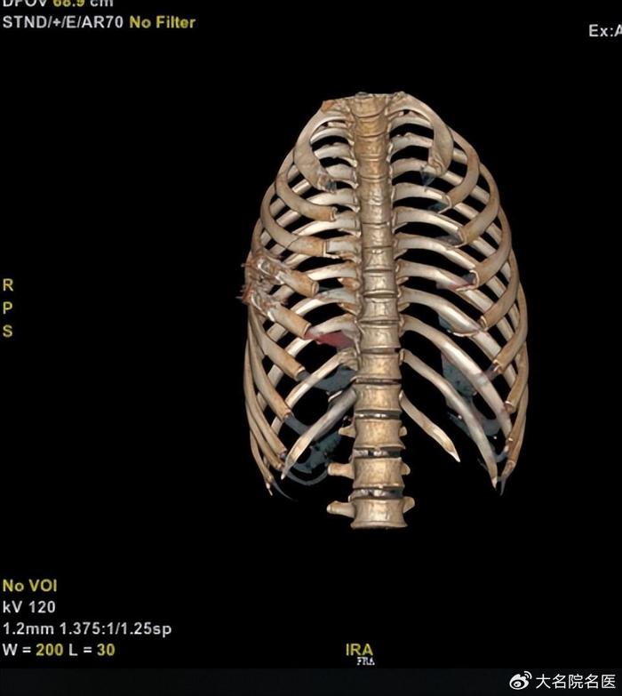 肋骨三维成像图片图片