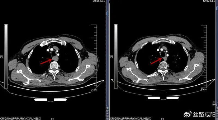 咸阳市中心医院——放射治疗:让食管癌老人顺畅吃饭
