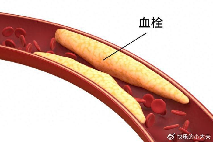 日常哪些习惯容易引起血栓?预防血栓记住这4点!|血栓|血栓形成|血液|动脉|血管_新浪新闻