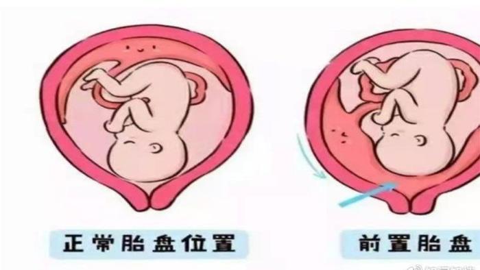 【原创科普】凶险性前置胎盘知多少