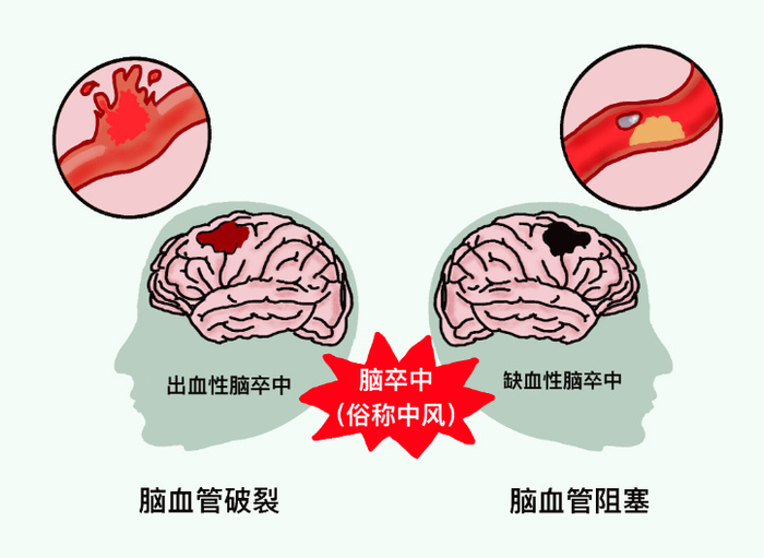 卒中又称"中风",是一种急性脑血管疾病,由于脑部血管突然破裂引起出血