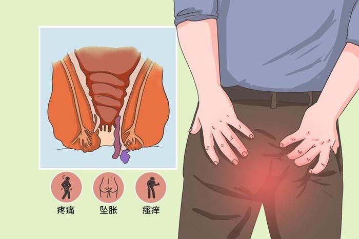 2,肛門腫物部分患者可觸及肛門周圍隆起的贅生物,肉眼