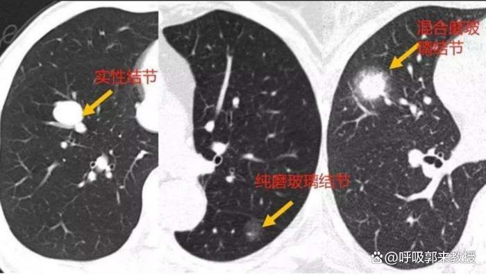 2024年九種基本是良性肺結節小知識 一定要認識到別