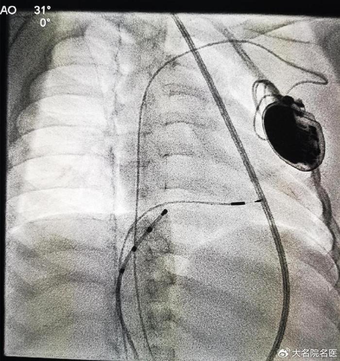 心脏起搏器安装后图片图片