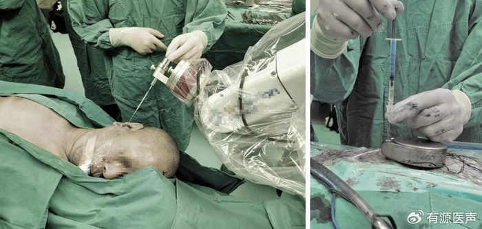湘雅医院完成华中地区首例脑室内给药吗啡泵植入术|吗啡|脑室|植入术