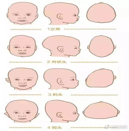 不止变丑,还有这些危害!|头型|宝宝|头颅_新浪新闻