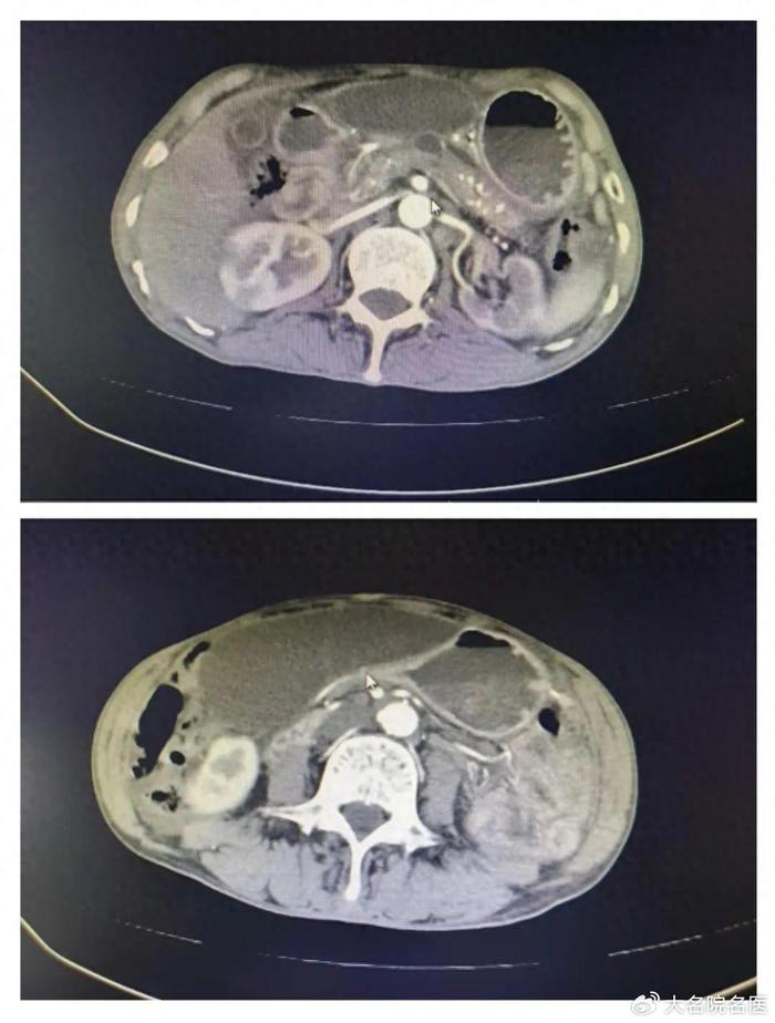 命悬胰腺 大伯患复杂胰腺疾病