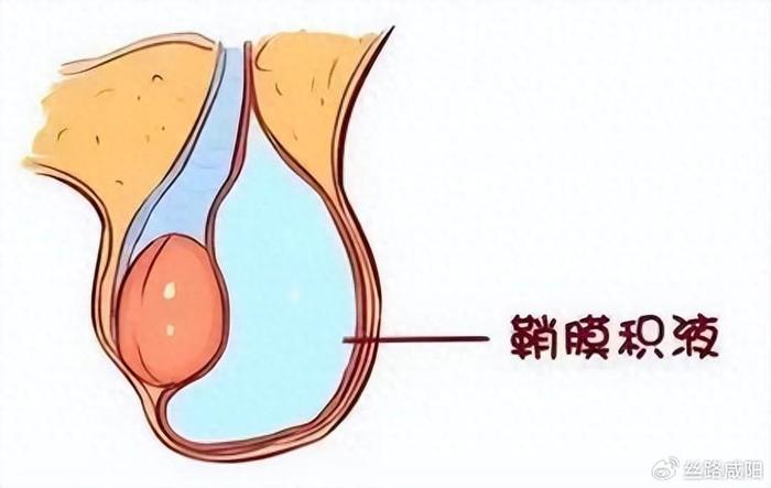 分泌增多,吸收的不多,睾丸鞘膜腔内就会形成积液