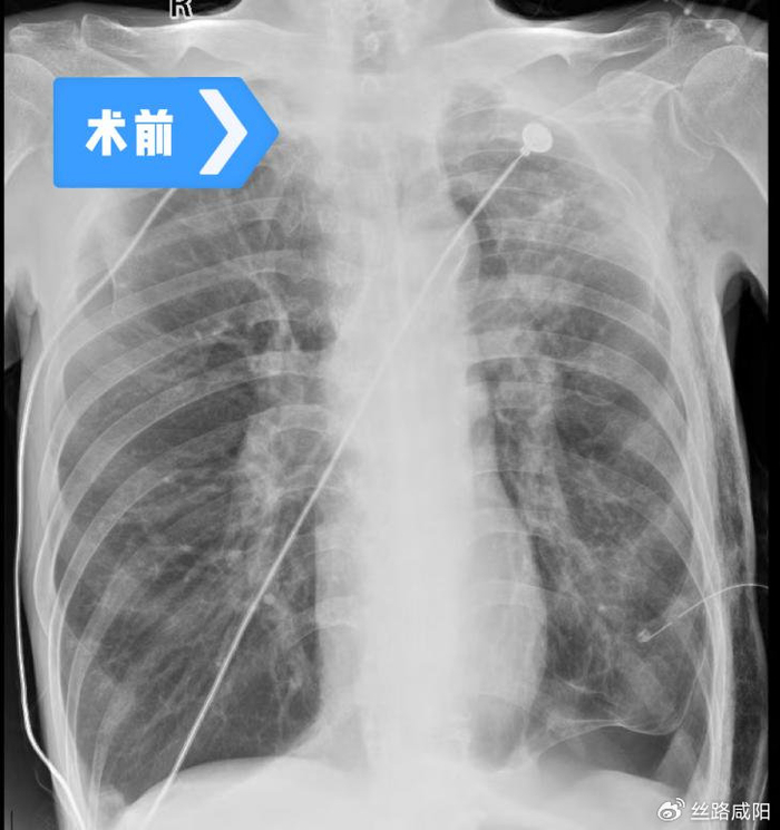陕中二附院胸外科团队 这么难治的气胸,好了!|肺大疱|气胸|胸外科_新浪新闻