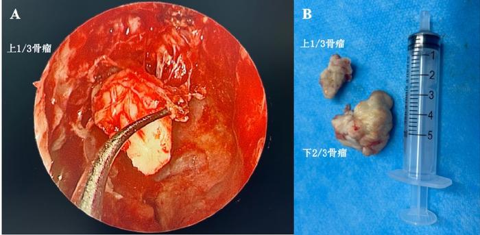 鼻窦骨瘤图片