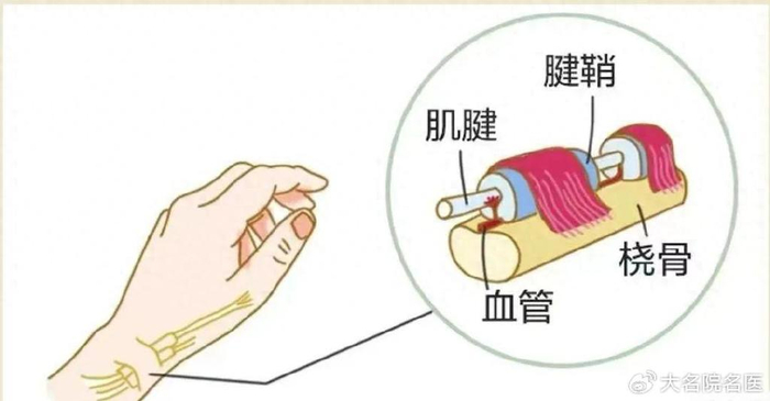 一,什么是手腕腱鞘炎?