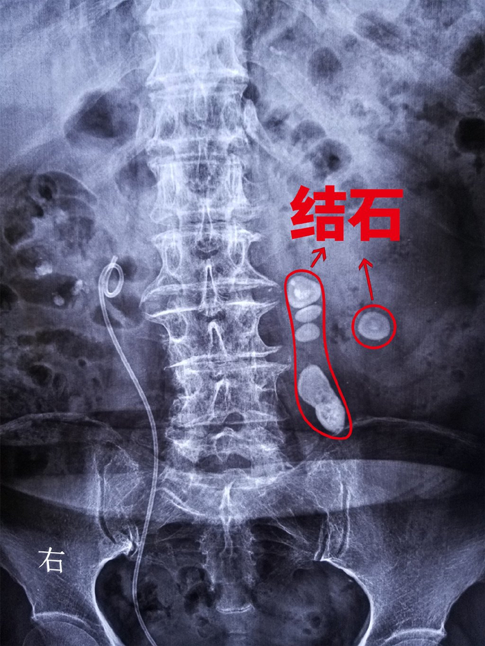 据悉,李娭毑是一个老结石患者,在三十多年前就因肾结石曾就医,当时