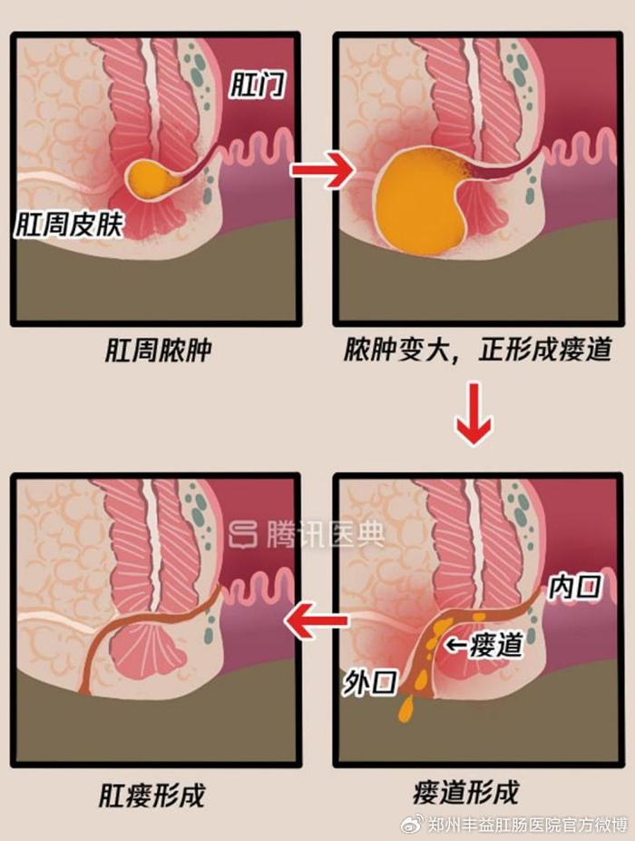 肛周脓肿初期硬块图片图片