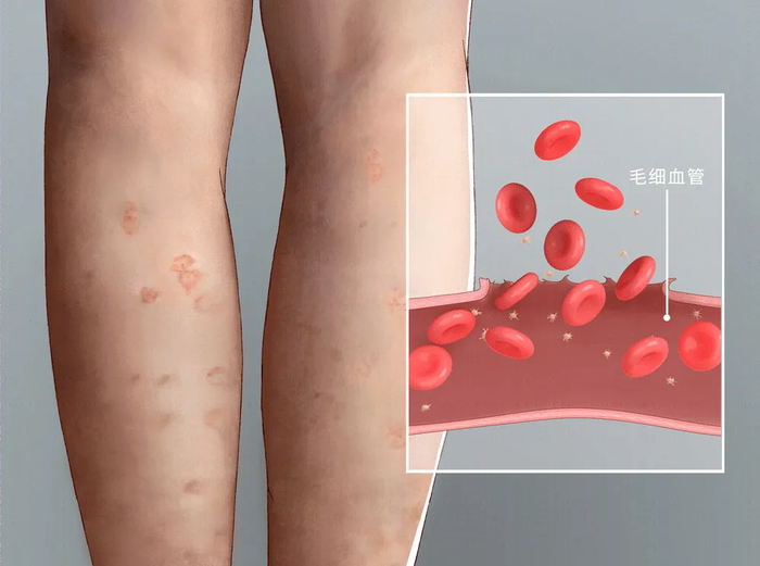 过敏性紫癜|患儿|淀粉_新浪新闻
