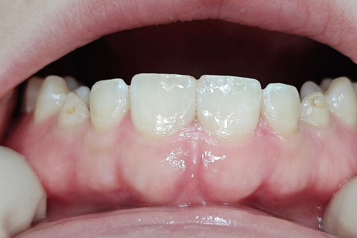 又拯救了一个牙缝