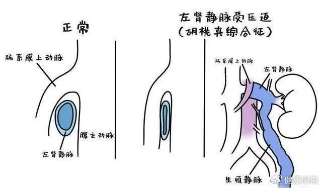 女性胡桃夹现象图片