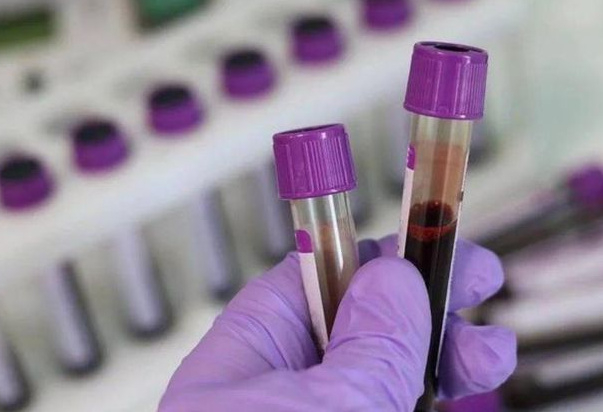 过敏性紫癜的四联症,如下:1,皮肤损伤:紫色或红色的瘀点和瘀斑,通常