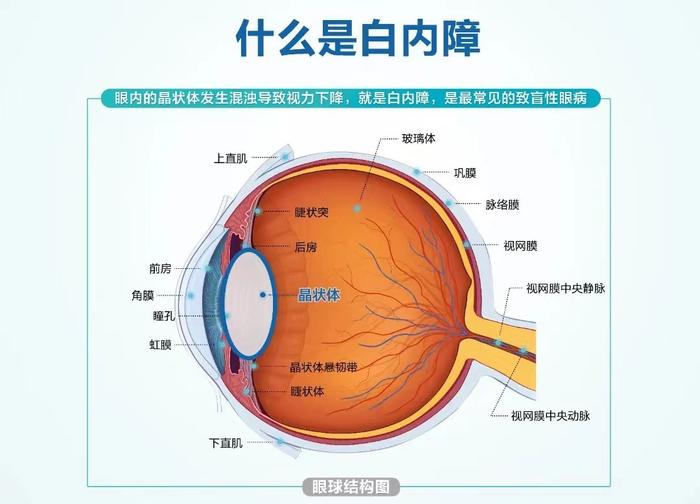 眼健康科普 白内障手术可以延长女性寿命?