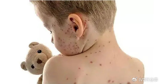 科研人员能够捕捉并放大样本中极其微量的手足口病相关肠道病毒rna