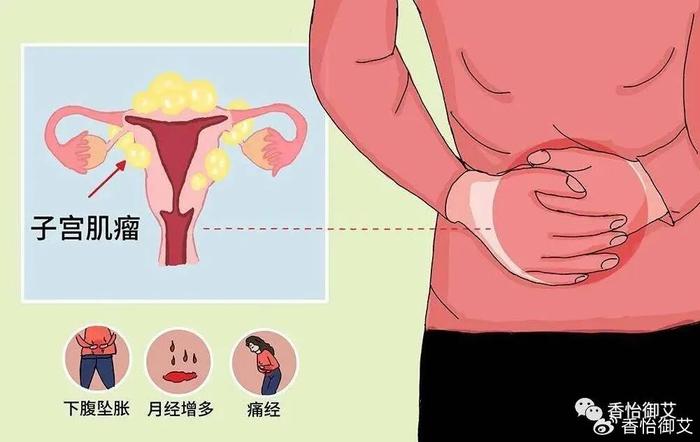 宮寒艾灸子宮腺肌症子宮肌瘤艾灸穴位和方法