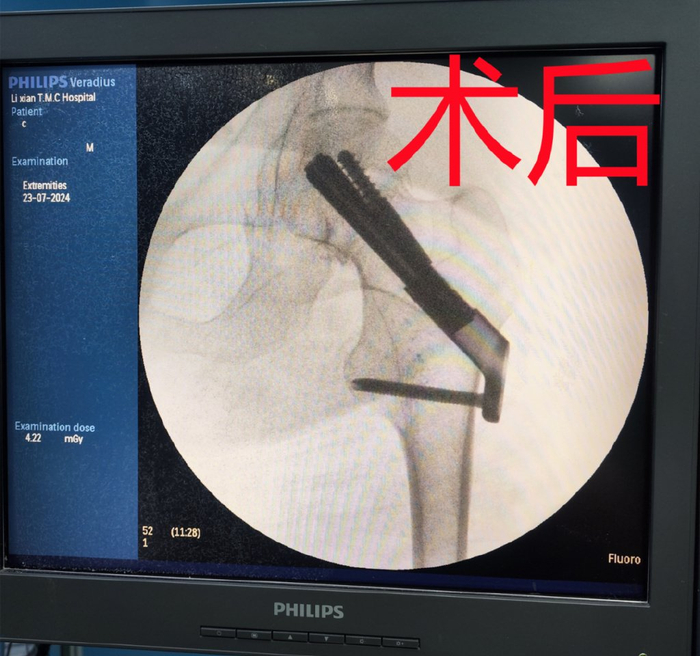 澧县中医医院首次应用fns系统治疗股骨颈骨折