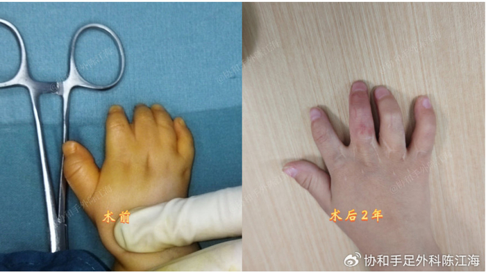 并指免植皮 | 案例42《1次手术+2年锻炼，宝宝小手好用疤痕也浅》