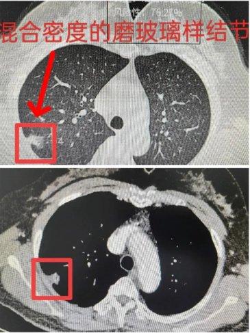 发现肺结节不要急,中医治疗来帮您