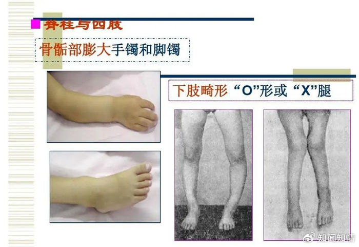 临床症状:维生素d缺乏佝偻病的患儿常出现睡觉不安稳,夜间哭闹,烦躁