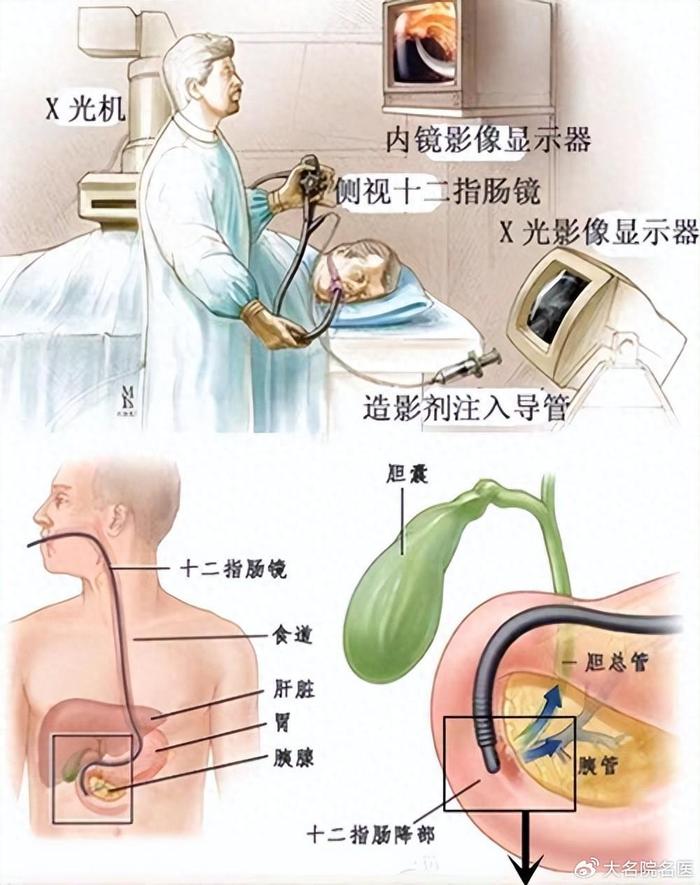 二人民医院普通外科采用腹腔镜 十二指肠镜双镜联合同期行微创手术