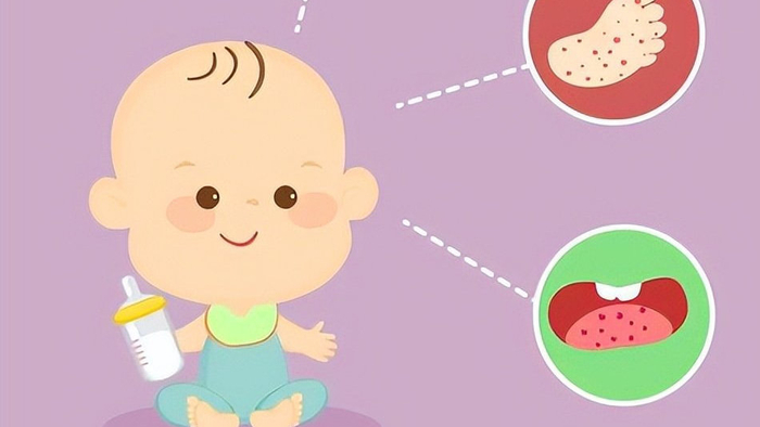 手足口病进入高发期，家长别忽视4类症状，5点预防知识赶紧学起来