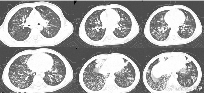 你想知道的都在这里|支原体|肺炎|支原体感染_新浪新闻
