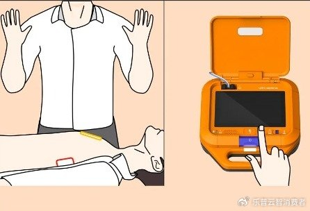 “救命神器”AED的使用指南与注意事项！ | 乐普说|医疗急救知识|急救|心跳骤停|心脏骤停|心肺复苏_新浪新闻