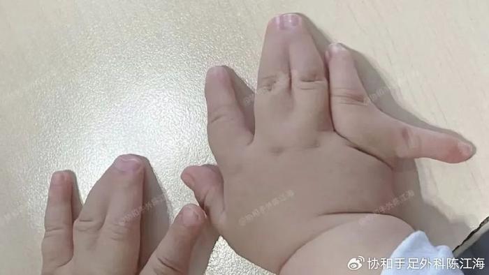 10个妈妈9个问麻醉，宝宝手术麻醉，一文给你说明白！（建议收藏）