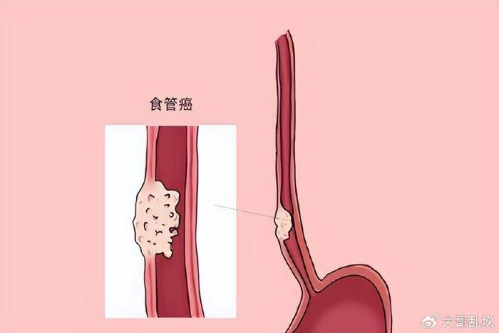 喉嚨如果出現這些症狀不是咽炎可能是食道癌上身