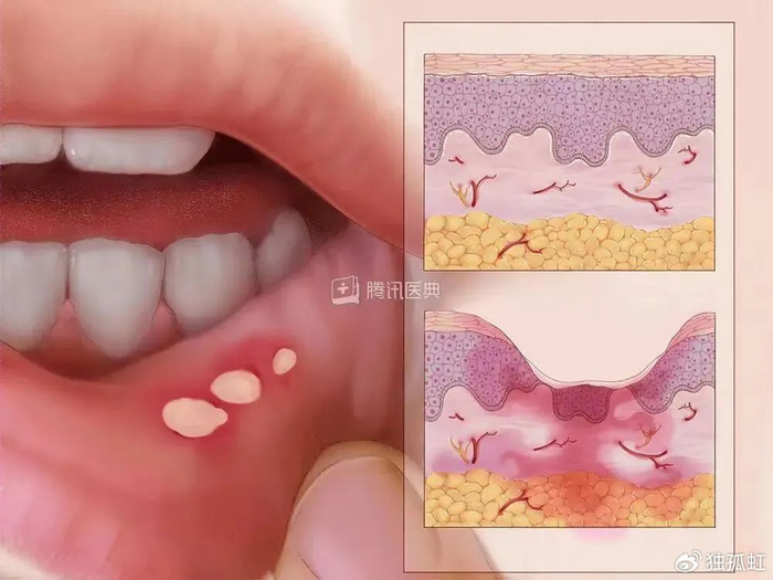 口腔溃疡焊死在我嘴里了，怎么办？|口腔溃疡|溃疡|复发性_新浪新闻